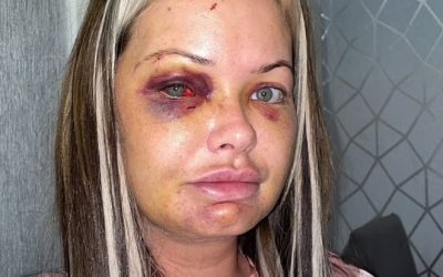 Mother-of-three horrifically Beaten by her boyfriend