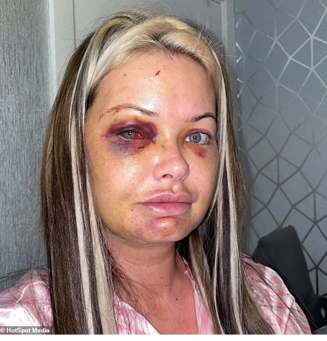 Mother-of-three horrifically Beaten by her boyfriend